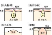 cf快速掉豆豆的方法有哪些？如何避免？