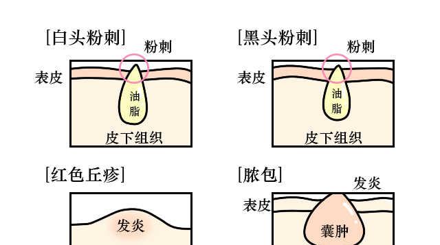cf快速掉豆豆的方法有哪些？如何避免？  第1张