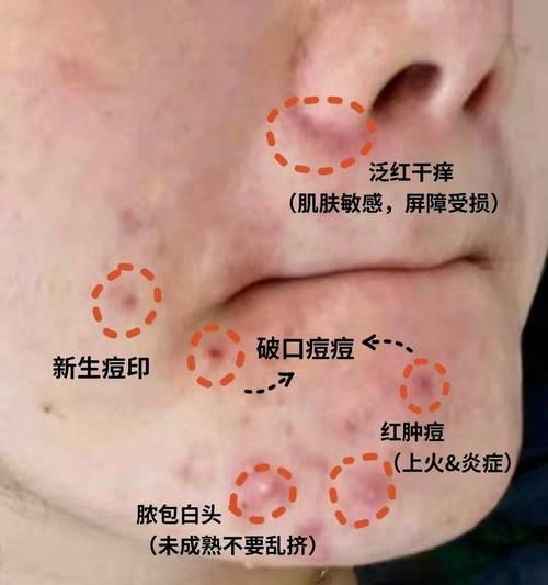 cf快速掉豆豆的方法有哪些？如何避免？  第3张